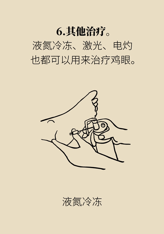 長(zhǎng)了雞眼和老繭怎么辦？這份防治指南請(qǐng)收好