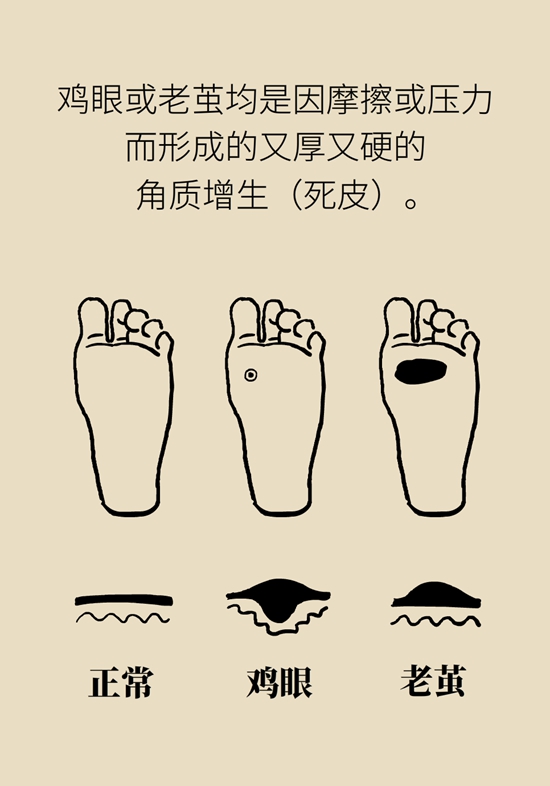 長(zhǎng)了雞眼和老繭怎么辦？這份防治指南請(qǐng)收好