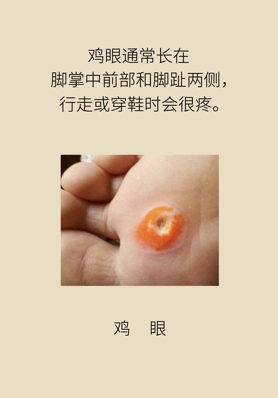 長(zhǎng)了雞眼和老繭怎么辦？這份防治指南請(qǐng)收好