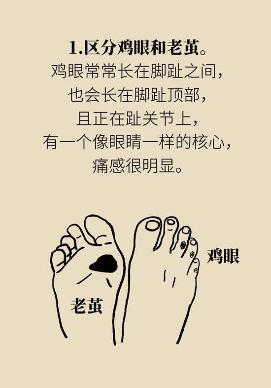 長(zhǎng)了雞眼和老繭怎么辦？這份防治指南請(qǐng)收好