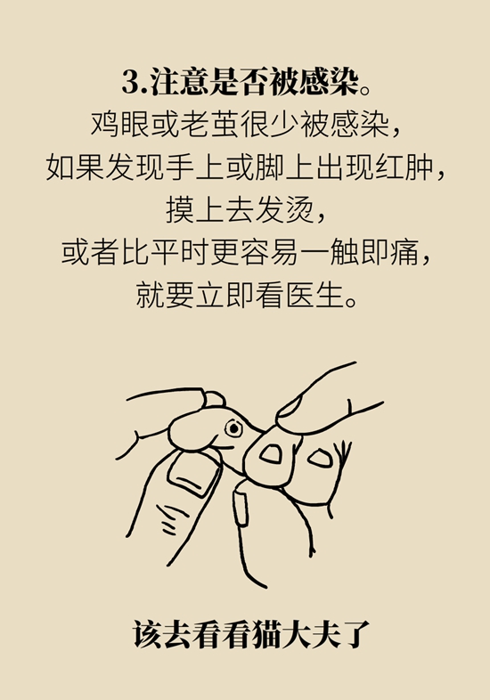 長(zhǎng)了雞眼和老繭怎么辦？這份防治指南請(qǐng)收好