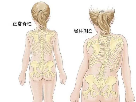 青少年睡姿不對，真能把脊柱睡“彎”嗎？