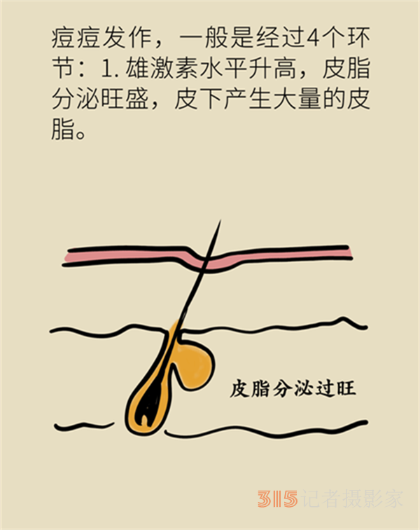 拯救顏值，請收下這份戰(zhàn)痘寶典！
