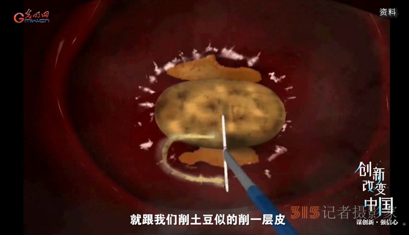 宮頸癌消滅戰(zhàn)：如何減少“梅艷芳式悲劇”？